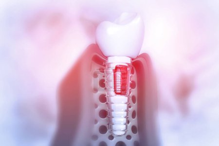 Foto de Implante dental dental en dentura humana. ilustración 3d - Imagen libre de derechos