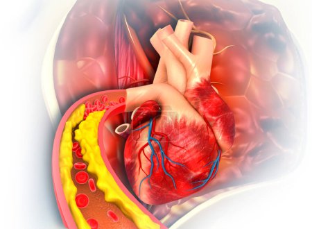 Téléchargez les photos : Coeur humain avec artère obstruée. Illustration 3d - en image libre de droit
