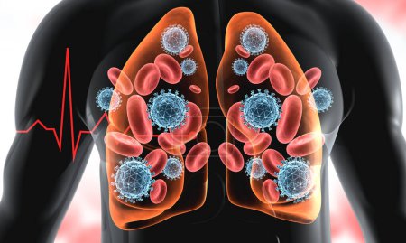 Foto de Coronavirus en los pulmones humanos. ilustración 3d - Imagen libre de derechos
