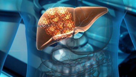 Photo for Human liver cancer cell growth. 3d illustration - Royalty Free Image