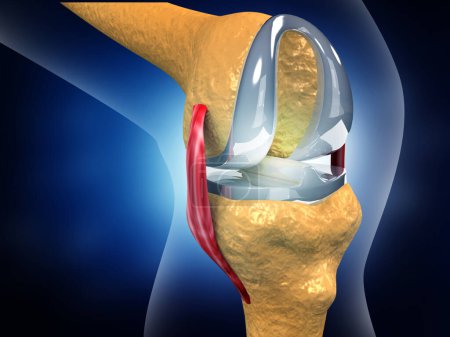 Photo for Human knee replacement implant. 3d illustration - Royalty Free Image