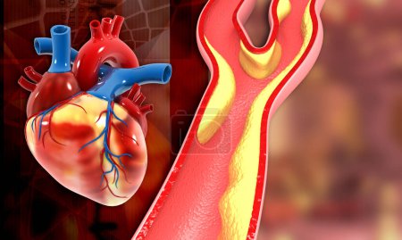 Photo for Blocked vein with heart. 3d illustration - Royalty Free Image