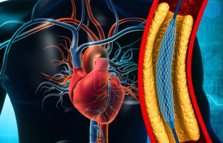 Téléchargez les photos : Coeur humain avec angioplastie ballonnette.Illustration 3d - en image libre de droit