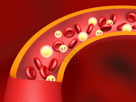 Téléchargez les photos : Cholestérol LDL dans les artères. Illustration 3d - en image libre de droit