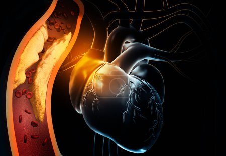 Foto de Corazón humano con arterias obstruidas. ilustración 3d - Imagen libre de derechos