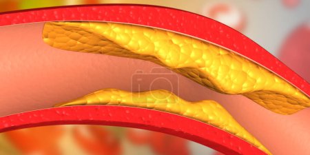 Téléchargez les photos : Le cholestérol bloque les artères. Illustration 3d - en image libre de droit