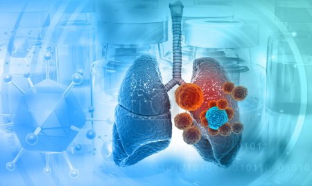 Foto de Cáncer de pulmón humano. diagrama de anatomía pulmonar. ilustración 3d - Imagen libre de derechos