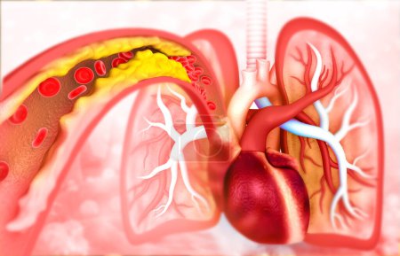 Foto de Arteria bloqueada con corazón humano. antecedentes médicos. ilustración 3d - Imagen libre de derechos