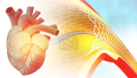 Téléchargez les photos : Coeur humain et angioplastie et pose d'endoprothèse. Illustration 3d - en image libre de droit