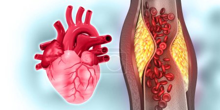 Téléchargez les photos : Le cholestérol bloque les artères avec le cœur humain. Illustration 3d - en image libre de droit