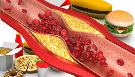 Foto de El colesterol bloqueó las arterias sobre un fondo alimenticio rápido. ilustración 3d - Imagen libre de derechos