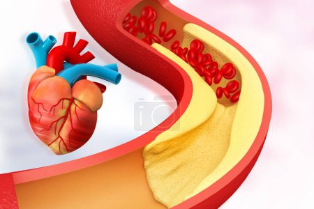 Téléchargez les photos : Le cholestérol bloque les artères avec le cœur humain. Illustration 3d - en image libre de droit