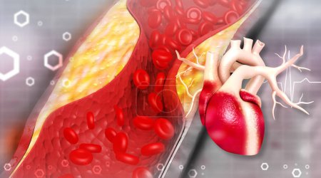Verstopfte Arterien beim menschlichen Herzen. Herzinfarkt. 3D-Illustration