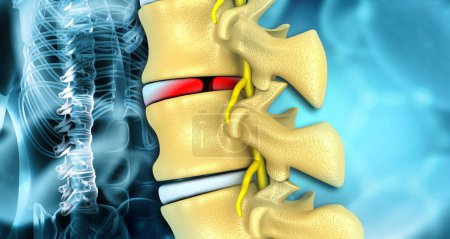 Human spine disc bulge. 3d illustration		