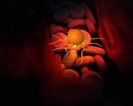 Foto de Células cancerosas y sistema inmunológico. ilustración 3d - Imagen libre de derechos