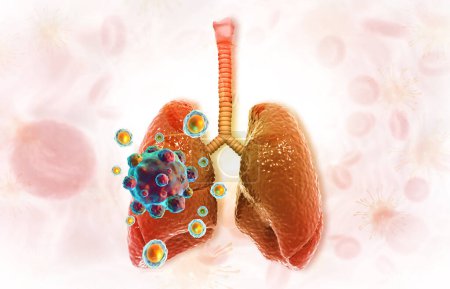Téléchargez les photos : Concept de cancer du poumon. Illustration 3d - en image libre de droit