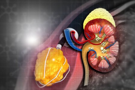Photo for Kidney stone removal with kidney anatomy. 3d illustration - Royalty Free Image