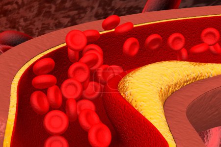 Photo for Clogged arteries, medical concept. 3d illustration - Royalty Free Image