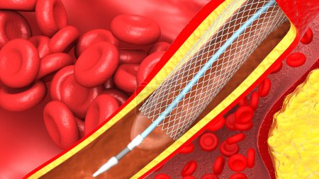 Photo for Clogged arteries, medical concept. 3d illustration - Royalty Free Image