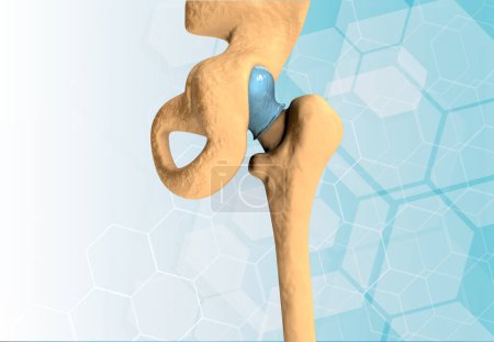 Photo for Hip joint replacement. 3d illustration - Royalty Free Image