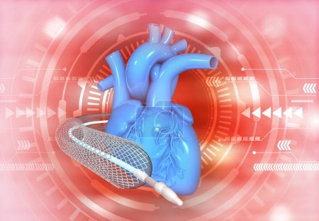 Photo for Angioplasty stent with human heart. 3d illustration - Royalty Free Image