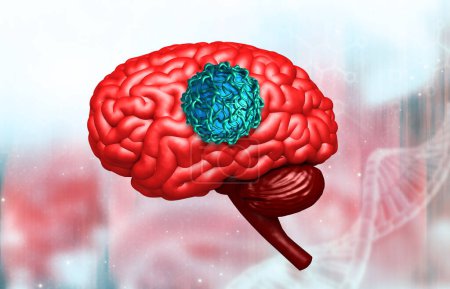 Foto de Concepto de tumor cerebral. ilustración 3d - Imagen libre de derechos