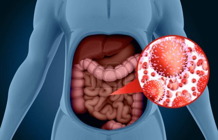 Foto de Infección por bactriea viral en el sistema digestivo. ilustración 3d - Imagen libre de derechos