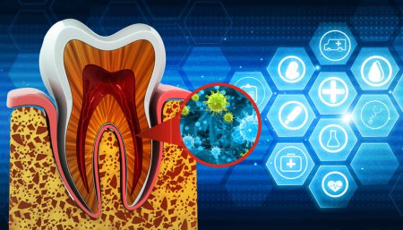 Bakterielle Infektion menschlicher Zähne. 3D-Illustration