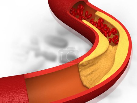 Arterie mit schlechtem Cholesterin blockiert. Verstopfte Arterien, koronare Arterienplaque. 3D-Illustration