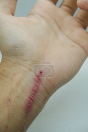 Photo for Cat scratch marks on wrist after a man tried to catch a domestic cat, man's arm isolated on white background. - Royalty Free Image