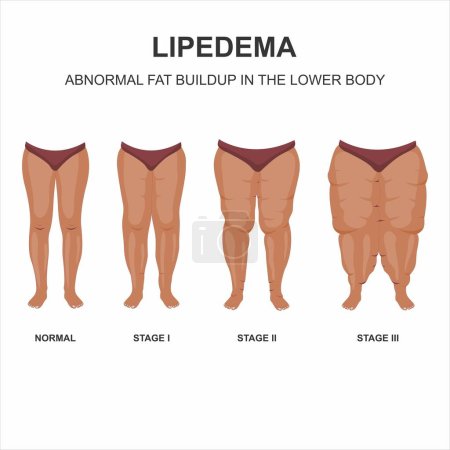 Lipedema stages in brown skin illustration
