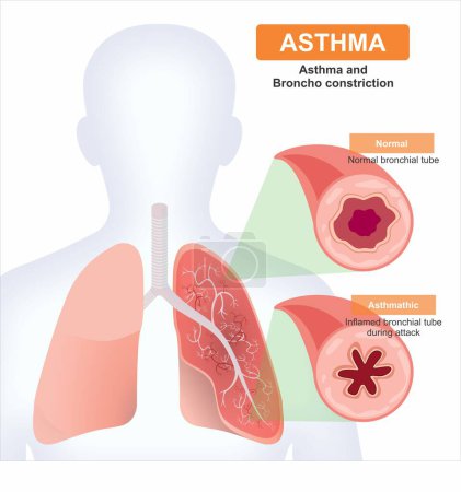 Téléchargez les photos : Asthme et constriction du broncho c section illustration médicale - en image libre de droit