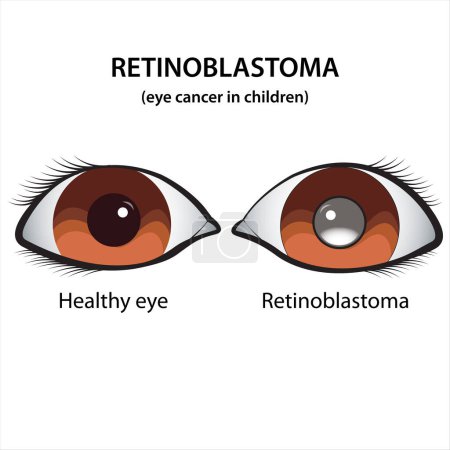 Photo for Retinoblastoma Eye cancer in children illustration - Royalty Free Image