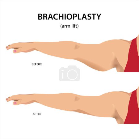 braquioplastia