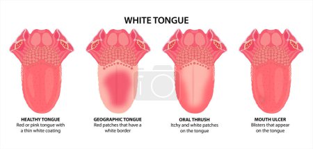 Illustration for White Tongue illustration, Oral thrush, Mouth ulcer and Geographic tongue - Royalty Free Image