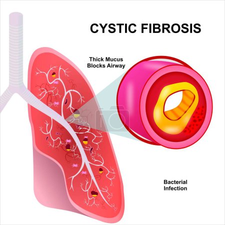 Illustration for Cystic fibrosis illustration infection on lungs - Royalty Free Image