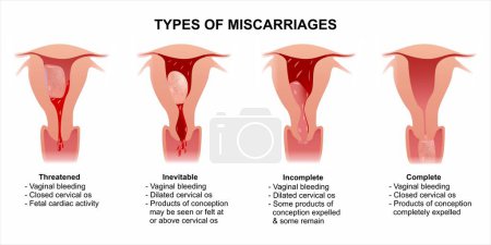 Illustration for Early pregnancy miscarriage types illustration - Royalty Free Image