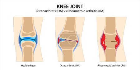 Téléchargez les illustrations : Arthrose articulaire du genou vs Polyarthrite rhumatoïde - en licence libre de droit
