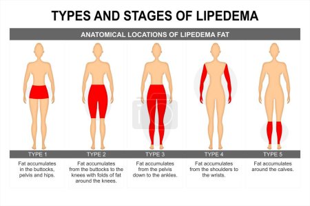 Illustration for Types of Lipedema Medical Educational Illustration - Royalty Free Image