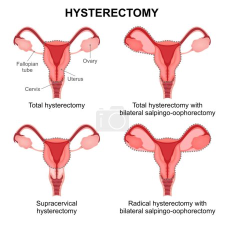 Illustration for Types of Hysterectomy medical illustration - Royalty Free Image