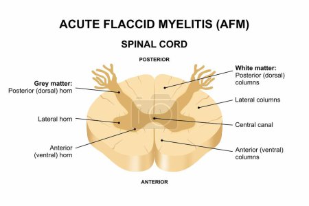 Acute Flaccid Myelitis (AFM)