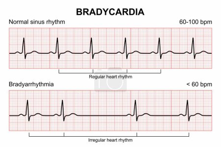 Bradycardia cardiogram of the heart vector illustration