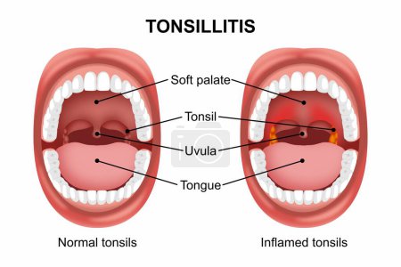 Tonsillitis throat infection inflamed tonsil illustration