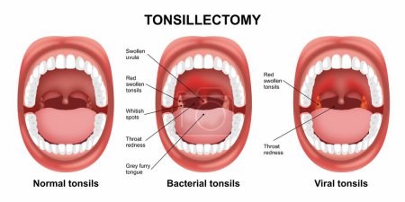 Illustration for Tonsillectomy throat Viral and Bacterial infection inflamed tonsil illustration - Royalty Free Image