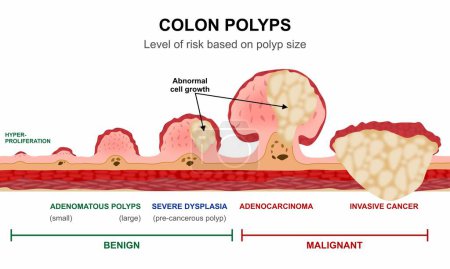 Colon Polyps Cancer Stages Illustration