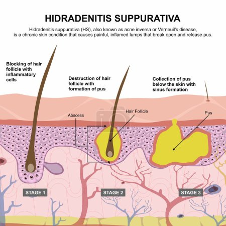Ilustración de Hidradenitis supurativa (HS) ilustración - Imagen libre de derechos