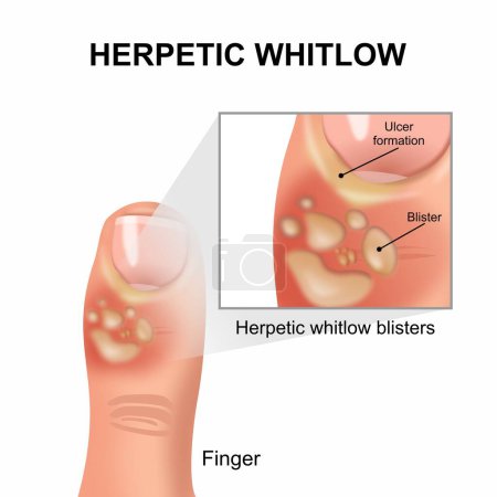 Herpetic whitlow infection in finger illustration