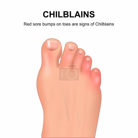 Chilblains redness sore bumps sign illustration