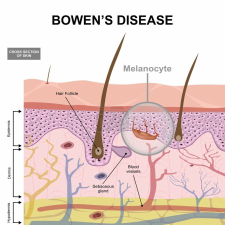 Coupe transversale de la peau humaine de la maladie de Bowen