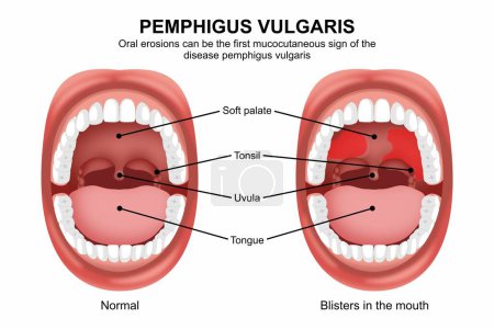 Pemphigus vulgaris mouth disease illustration